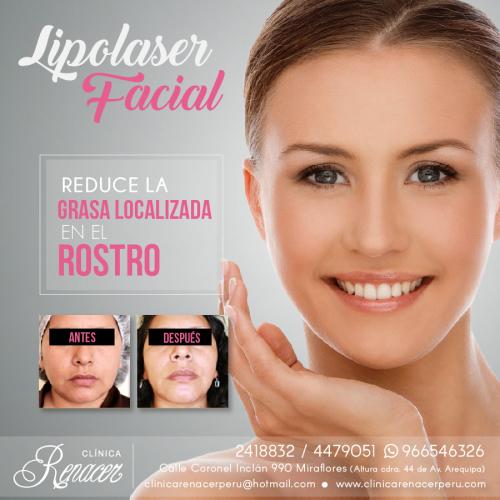 Elimina la grasa facial  Clínica Renacer  L - Imagen 1
