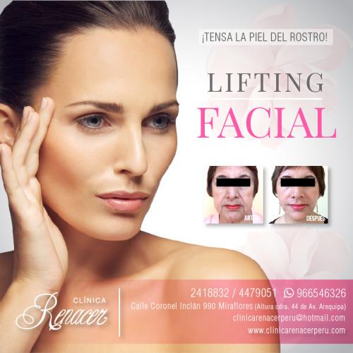 Estiramiento facial  Clínica Renacer Liftin - Imagen 1