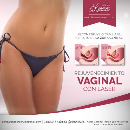 Recupera la firmeza vaginal  Clínica Renace - Imagen 1